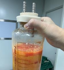 博兴水动力吸脂手术要做多久？